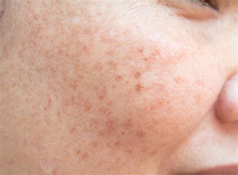 Understanding Acne Marks vs Acne Scars to Restore Your Skin