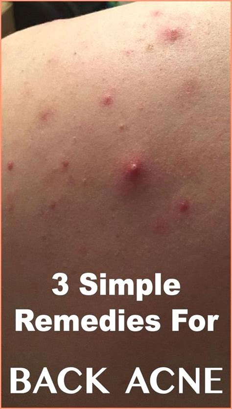 3 Best Remedies For Back Acne Medicine Health Life