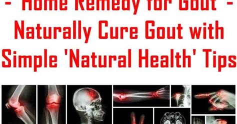 Easy Gout Treatment And Prevention Tips Home Remedy For Gout