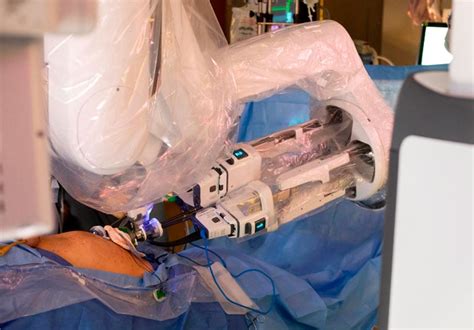 Single Port Robotics Reduce Incisions May Lead To Less Pain And Quicker Recovery From