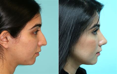 Rhinoplasty Photos Chevy Chase Md Patient 16295