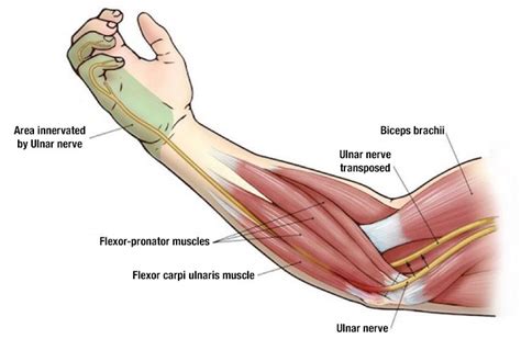Ulnar Neuropathy Cubital And Ulnar Tunnel Syndrome Orthomed Canada