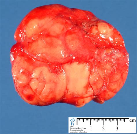 You have to be vaccinated by astrazeneca. adipocytic tumors - Humpath.com - Human pathology