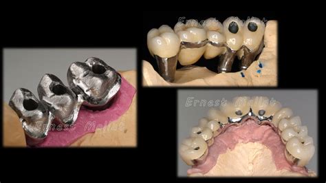 Algunos Detalles En Prótesis Fija Sobre Implantes Drernest Mallat Prosthodonticsmcm