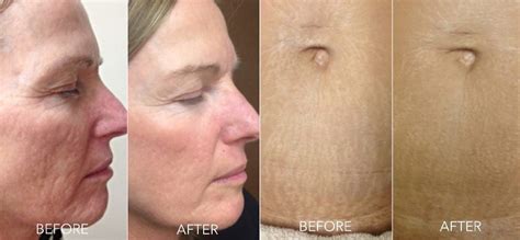 Microneedling Before After Impressions Medispa