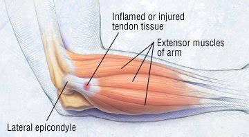 This is the second tendon that works to bend back the wrist. Tendonitis Guide: Causes, Symptoms and Treatment Options
