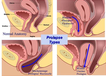 Physio 4U Pelvic Organ Prolapse
