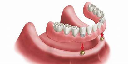 Locator Implant Implants Dental Overdentures Teeth Air