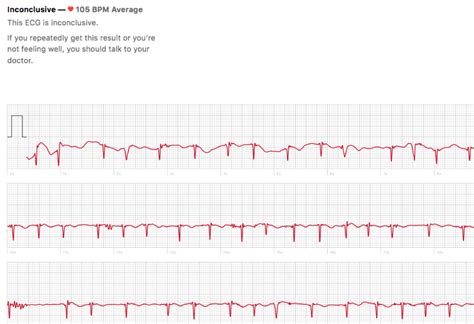 Putting The Apple Watch 4 Ecg To The Test In Atrial Fibrillation An