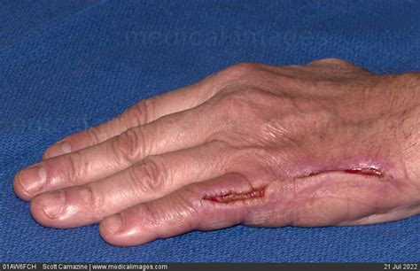 STOCK IMAGE, hand laceration series showing the stages of wound healing ...
