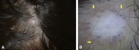 Starburst Hair Follicles A Dermoscopic Clue For Aplasia Cutis