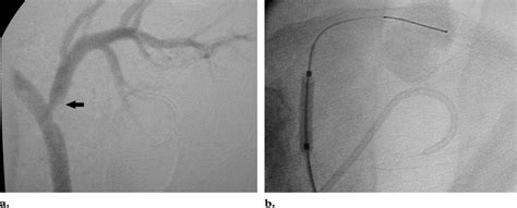 Percutaneous Transluminal Angioplasty Of A Renal Artery Stenosis A