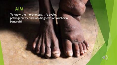 Lymphatic Filariasis Along With Explanation Youtube