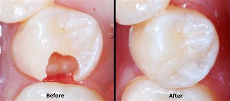 Safest Permanent Dental Fillings The Best So Far Oralhealthcomplete