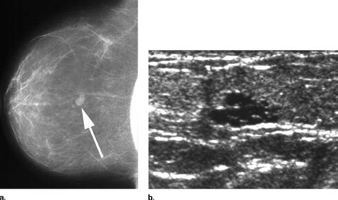 Complicated Breast Cysts On Sonography Academic Radiology