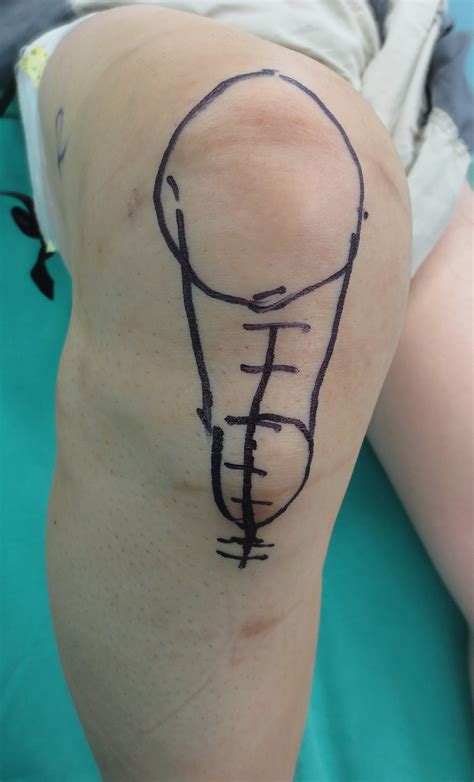 Open Patellar Tendon Tenotomy And Debridement Combined With Suture