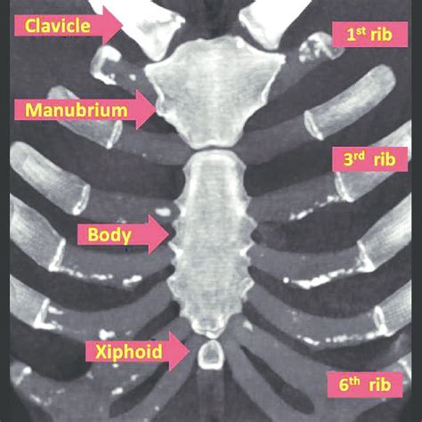 Coronal Volume Rendered Image Of Sternum Shows Non Fused Sternal Body
