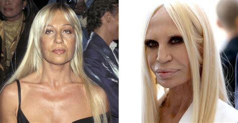 Donatella Versace Plastic Surgery Disasters Purple Clover