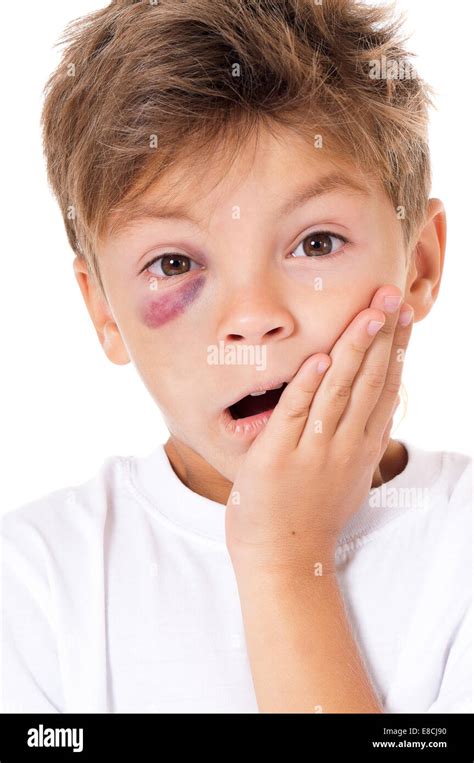 Boy With Bruise Stock Photo Alamy
