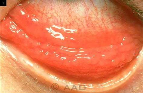 The Case Of Stubborn Conjunctivitis American Academy Of Ophthalmology
