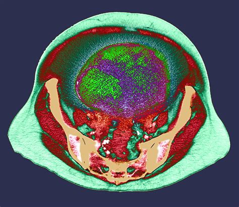 Ovarian Cancer Ct Scan Photograph By Du Cane Medical Imaging Ltd