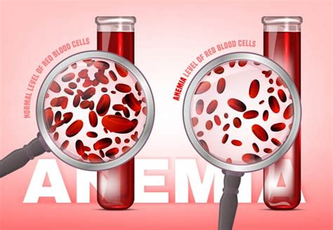 morphological and etiological classifications of anaemia or anemia