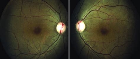 Fundus Photograph Of Both Eyes Showing Attenuation Of Vessels And An