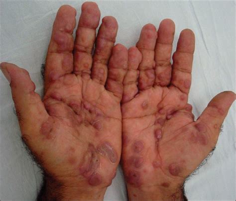 Multiple Nodular Swellings In An Adult Male Yadav S De D Saikia Un
