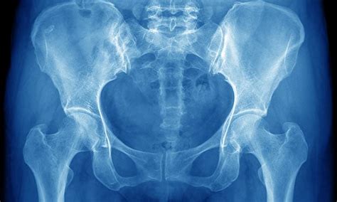 nhs outsourcing 10 times more hip replacements than a decade ago