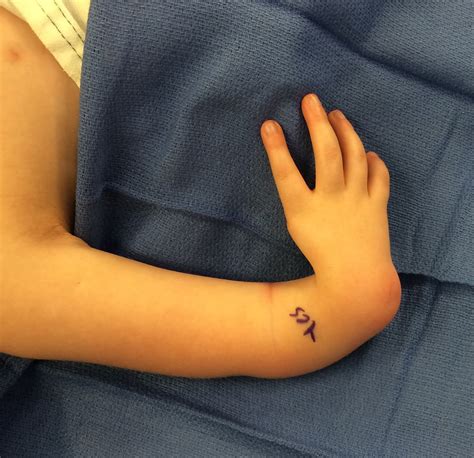 Function In Radial Deficiency Congenital Hand And Arm Differences