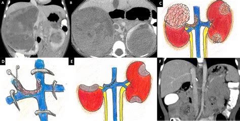 Management Of Intravascular Thrombus In Cases Of Bilateral Wilms Tumor