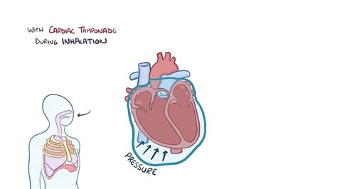 Cardiac Tamponade Causes Symptoms Diagnosis Treatment Pathology