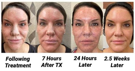 Abszess Grab Erwartung Laser Skin Resurfacing Healing Process Tags Ber Hell Schei E