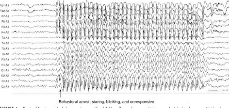 Figure 14 From The Eeg In Selected Generalized Seizures Semantic Scholar