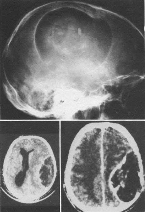 Giant Intradiploic Epidermoid Cysts Of The Skull In Journal Of