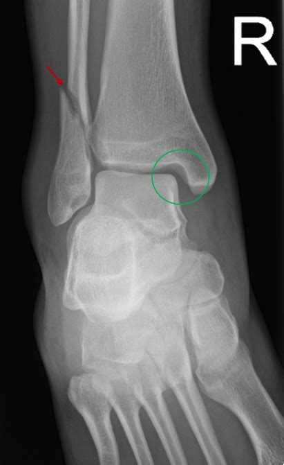 Fractured Ankle X Ray