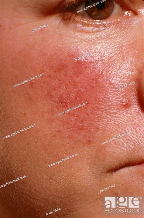 Acne Rosacea Stock Photo Picture And Rights Managed Image Pic Bsi