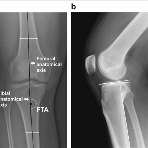 Femorotibial Angle And Posterior Tibial Slope Measurements A The