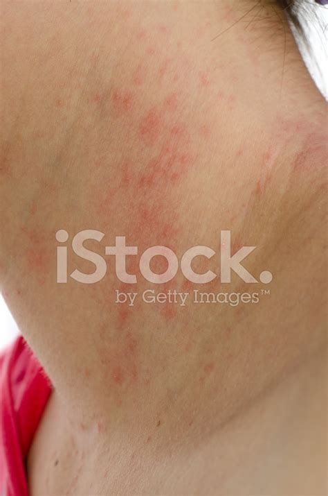 Eczema Skin On Neck Stock Photos