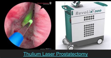 Thulium Laser Vapoenucleation Of The Prostatethulepthulium Laser