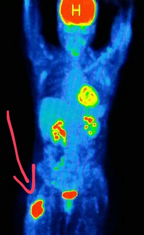 Pet Scan Shows A Malignant Tumor Cancer In The Hip Femur