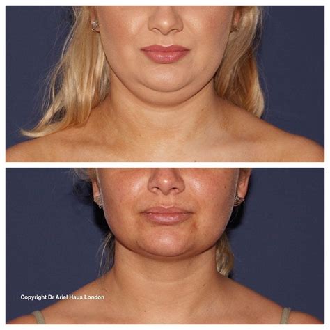 Chin Fat Double Chins Dr Haus Dermatology