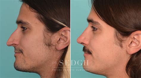 Hispanic Rhinoplasty Before And After Photos Dr Sedgh