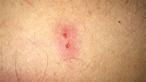 A spider or other insect in your ear will likely die eventually, but by then you would probably be poking around in there trying to get rid of it and damage your eardrum permanently. How To Treat Flea Bites At Your Home - Healthrow.net