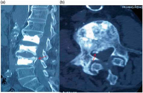 Delayed Neurological Deficits Caused By Cement Extravasation Following