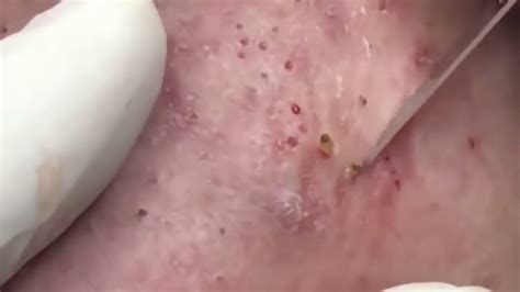 Blackhead Removable Cystic Acne Extraction Ancy Esthetician Zit Chow Stephen Youtube