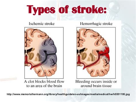 The Lancet Stroke Is Largely Preventable With Hypertension Confirmed