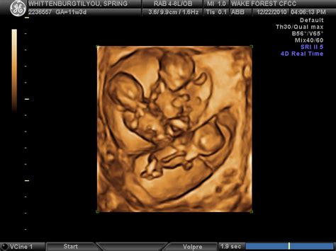 30 fingers 30 toes first trimester photos and ultrasounds
