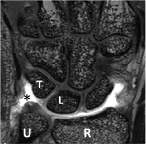 Figure 1 From Prestyloid Recess Of The Wrist Normal Appearance On 3t