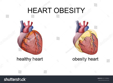 Illustration Obesity Heart Comparison Vetor Stock Livre De Direitos